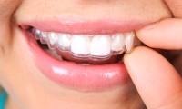 Ortodoncia Invisalign